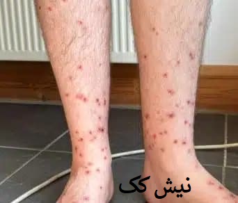 گزش کک روی بدن
